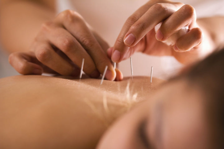 Holistic Healing?  Part 1: The Benefits of Acupuncture